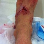 foot_injury