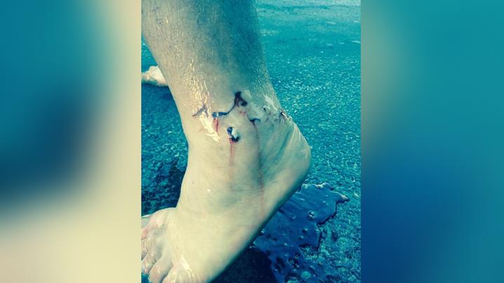 Paddle-boarders injury Photo: Danny Freeman