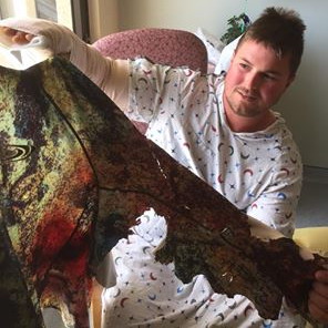 Senkowicz shows his shark bitten dive skin. :Facebook