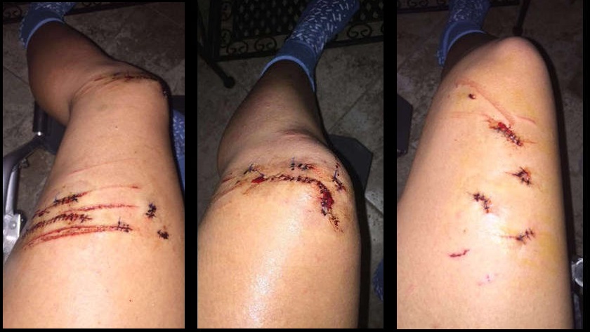 Graphic Teen Bitten By A Shark In Destin Florida