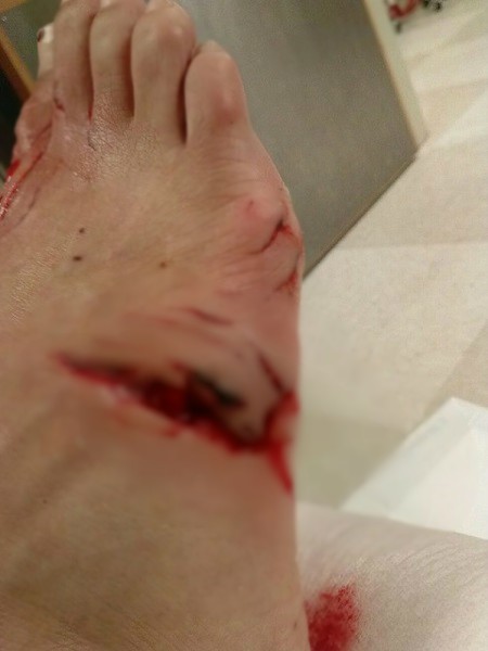 _wound_Kerry_Keyton_2017_shark_attack_bite_St_Augustine_Pier_Florida_