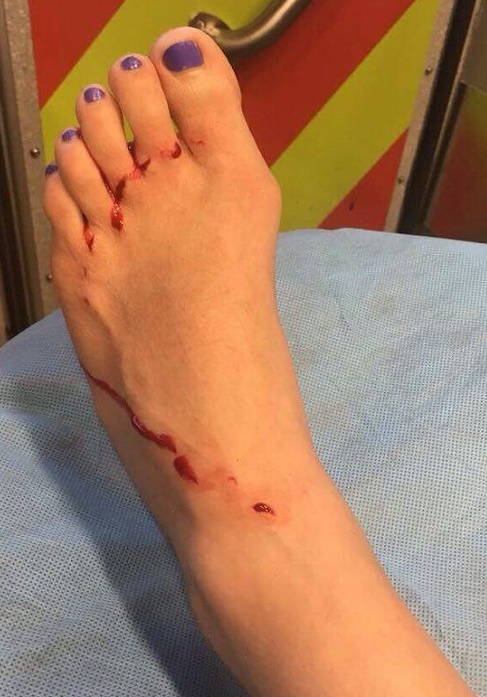 2017_shark_attack_bite_South_Carolina_Holly_Dyar_wound_1
