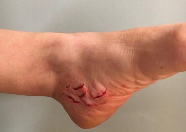 2017_shark_attack_bite_South_Carolina_Holly_Dyar_wound_2