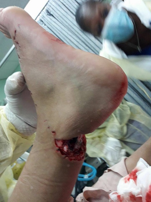 requin bite 