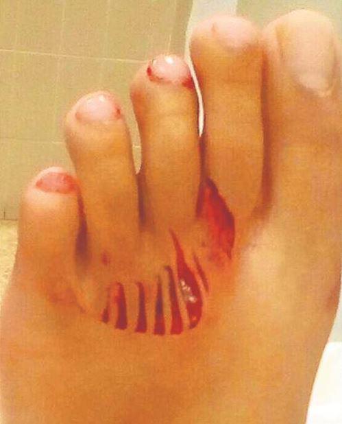 shark_attack_bite_spain