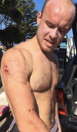 2017 shark attack bite_Avooca Beach_NSW_Charlie Fry