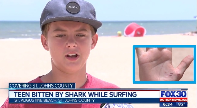 Hunter Hylton was shark bitten at St Augustine Beach Florida