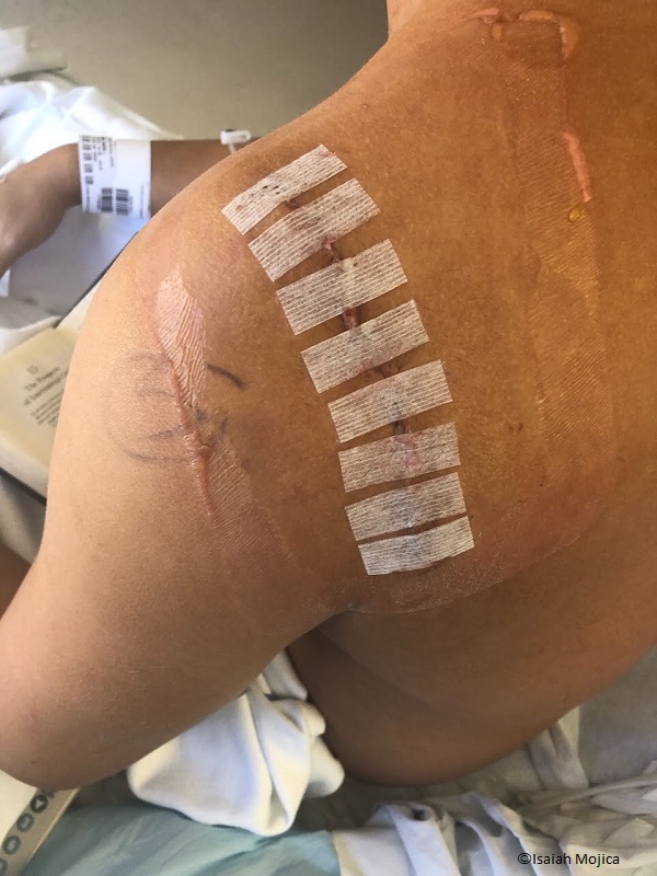 Isaiah Mojica shoulder after being bitten by a cookiecutter shark