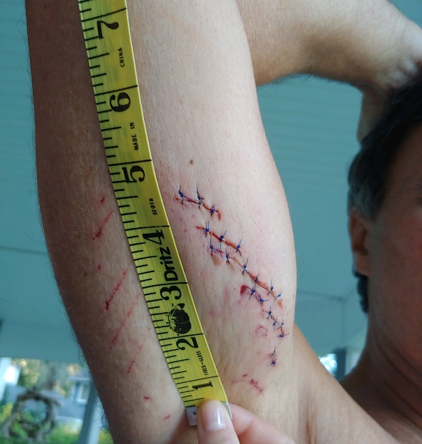 Gene Brooks showing his scar from a shark attack Savannah, Georgia