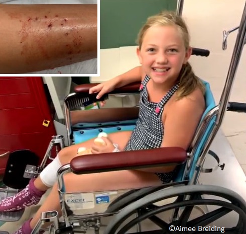 9-year-old Maggie Crum was bitten by a shark in Florida