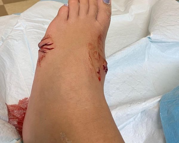 A shark bitten foot. 
