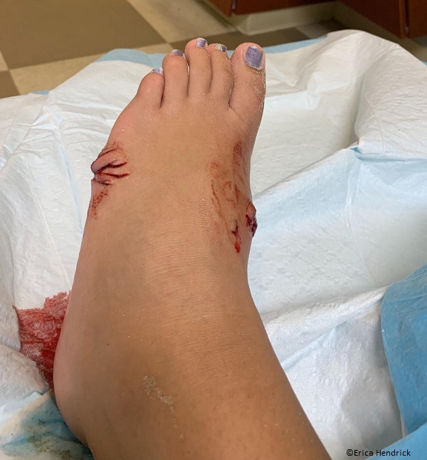 south Carolina shark bite wound