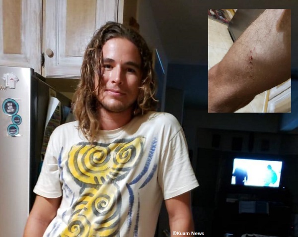Rain Williams was bitten by a shark in Guam.