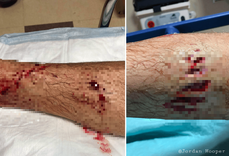 Shark bite wound