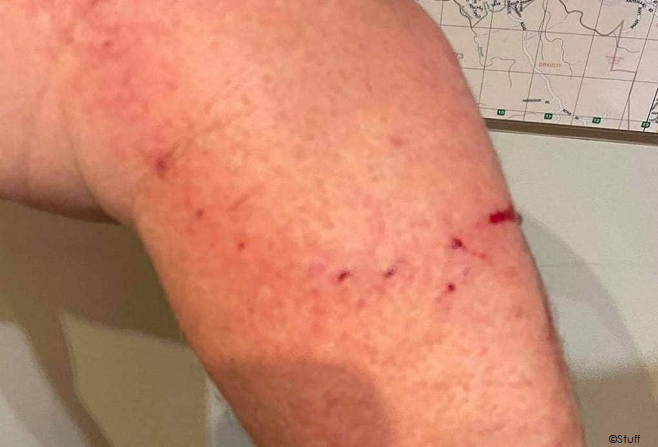 Shark bite in New Zealand