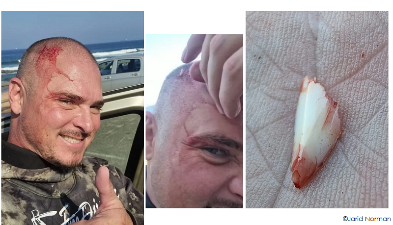 Jarid Norman shark attack leaves tooth in man's head