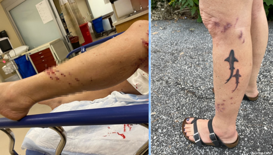 Redington Shores Flroida shark attack wound photo