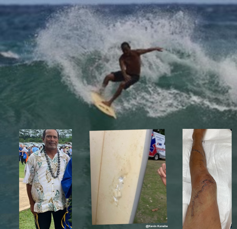 Kevin Kanehe leg and shark damaged surf board.